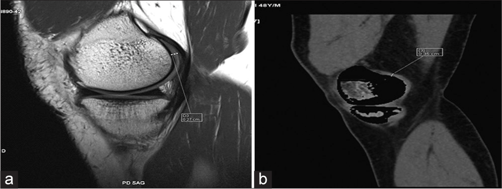 (a) Proton density sagittal magnetic resonance image shows medial femoral tibial cartilage thickness. (b) Sagittal dual-energy computed tomography with calcium suppression technique image shows medial femoral tibial cartilage thickness.