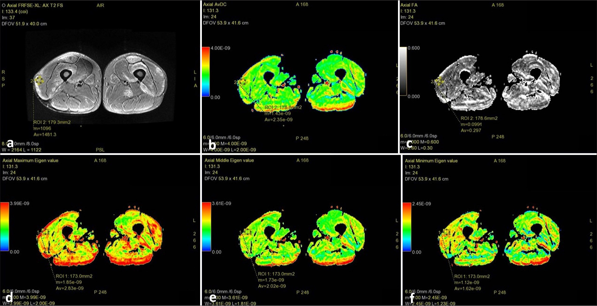 Magnetic resonance imaging thigh of a patient with inflammatory myopathy showing: (a) Axial T2 fat saturated image showing muscle edema with a slice of the muscle selected that contained maximum signal intensity to place region of interest; (b) diffusion tensor imaging apparent diffusion coefficient (average 2.35 e–09); (c) fractional anisotropy (average 0.297); (d) λ1 value (average 2.83 e–09); (e) λ2 value (average 2.02 e–09); and, (f) λ3 value (average 1.62 e–09).