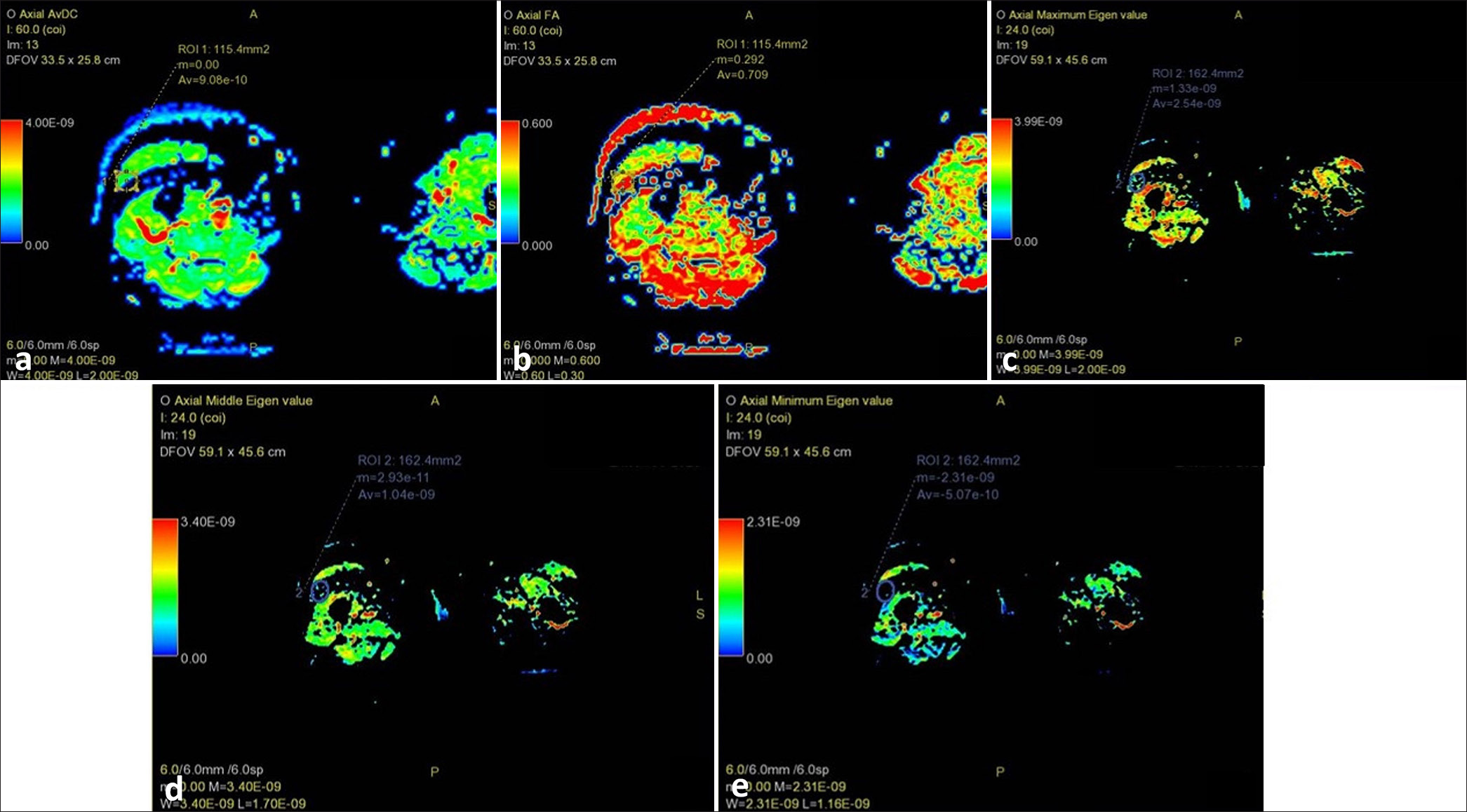 Magnetic resonance imaging thigh of a healthy control showing selection of mid-slice of vastus lateralis for placing region of interest: (a) diffusion tensor imaging apparent diffusion coefficient (average 9.08 e–10); (b) fractional anisotropy (average 0.709); (c) λ1 value (average 2.54 e–09); (d) λ2 value (average 1.04 e–09); and, (e) λ3 value (average 5.07 e–10).