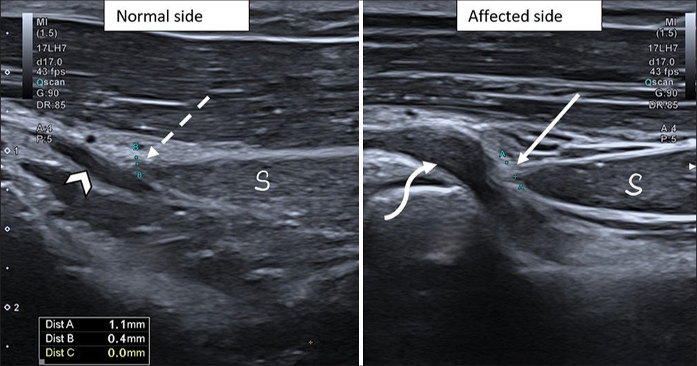 Comparative sagittal ultrasound scan of bilateral forearms at the level of entry of supinator tunnel was performed – the posterior interosseous nerve appeared significantly thickened on the affected side (curved arrow) in comparison to the contralateral normal side (arrowhead).Thickness of the ligament of Frohse was compared – it measured 0.4 mm on the normal side (dashed arrow) but was significantly thickened on the affected side and measured 1.1 mm (solid arrow). S: Superficial head of supinator muscle.