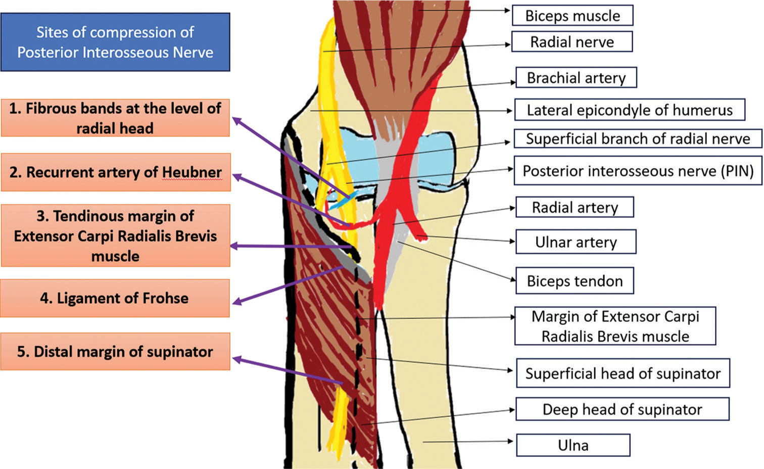 Schematic diagram showing the possible sites of compression of posterior interosseous nerve around the elbow joint.