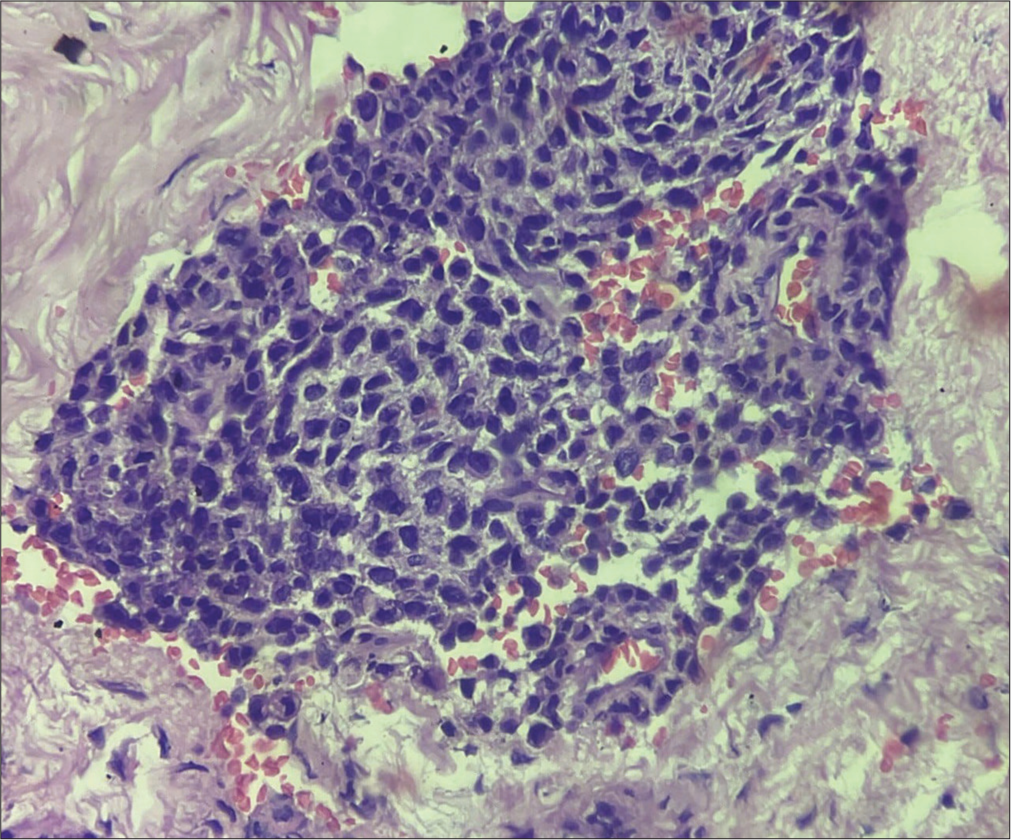 Nest of ovoid to plasmacytoid cells having monomorphic round nuclei, inconspicuous nucleoli, and clear cytoplasm (×40, hematoxylin and eosin stain).