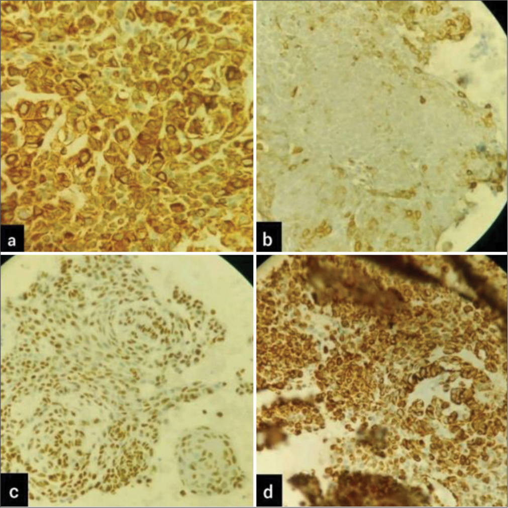 Immunohistochemistry slides postive for (a) AE-1 (b) p40 (c) CK5/6 (d) vimentin markers.