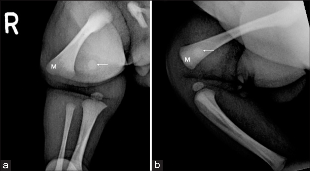 Two-day-old neonate with Salter-Harris I fracture of the distal right femur. (a) Frontal and (b) lateral radiographs of the right knee revealed loss of congruence between the distal femoral epiphysis (arrow) and metaphysis (M).