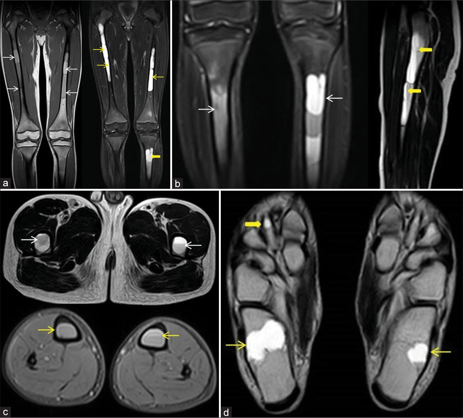 (a) Long field of view T1-weighted spin-echo (SE) coronal and fluid sensitive fat saturated (STIR) coronal magnetic resonance (MR) images show long segmental near confluent cystic lesions involving near total medullary cavities of both femurs (white and yellow arrows) and tibia (thick yellow arrow) showing bright hyperintense signals on STIR images (thin yellow arrows) and few associated T1 hyperintensities (white arrows) suggesting internal hemorrhages. (b): Coronal fluid STIR MR image of both tibia (white arrows) and T2-weighted (T2W) SE sagittal MR image of left femur demonstrate internal fluid- fluid levels (thick yellow arrows). (c) Axial T2W SE and T2W gradient echo MR images of both thighs and legs demonstrating the internal fluid-fluid/blood fluid levels within the cysts at both femurs (white arrows) and tibia (yellow arrows). (d) Axial T2W SE MR image of both feet shows small intraosseous cysts involving bilateral calcaneal bones (thin yellow arrows) and right 2nd metatarsal bone (thick yellow arrow).