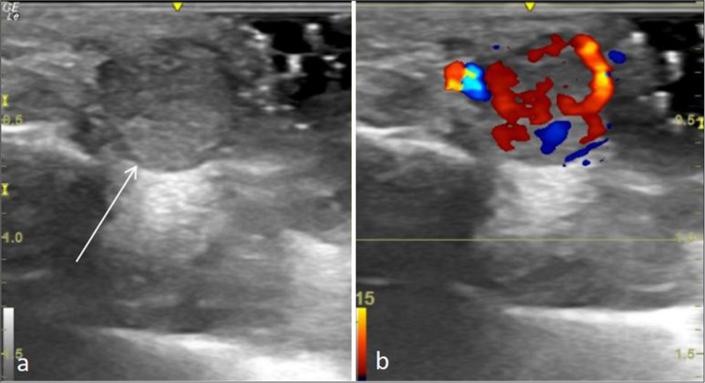 A 27 year-old woman with an arteriovenous fistula of the digit presented with swelling over her left middle finger. (a) Ultrasound of the lesion with the probe perpendicular to the long axis of the finger shows a well defined heterogenously hypoechoic lesion in the subcutaneous plane (arrow). (b) Colour Doppler shows vascularity within the lesion.