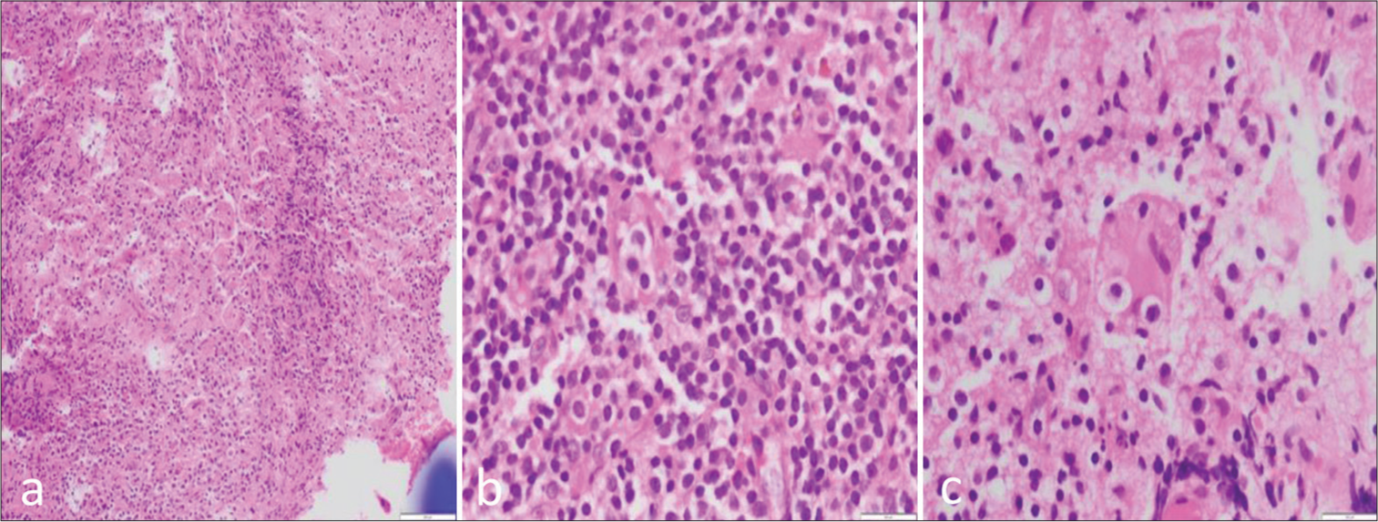 (a-c) Histopathological sections show fragments of fibro collagenous tissue displaying a heterogeneous infiltrate composed of sheets of histiocytes admixed with plenty of plasma cells, lymphocytes, and neutrophilic microabscesses. The histiocytes are large with pale, foamy cytoplasm, and some of them contain engulfed neutrophils, lymphocytes, and plasma cells suggestive of emperipolesis.