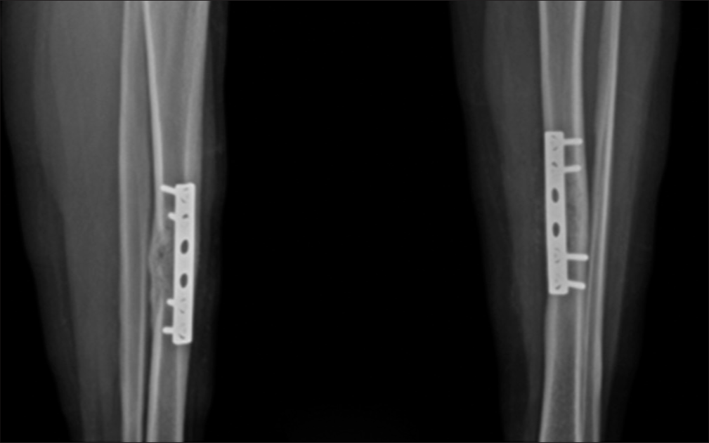 Post-operative radiograph showing cortical thickening with good osseous consolidation. Plate and screws fixation is in situ.