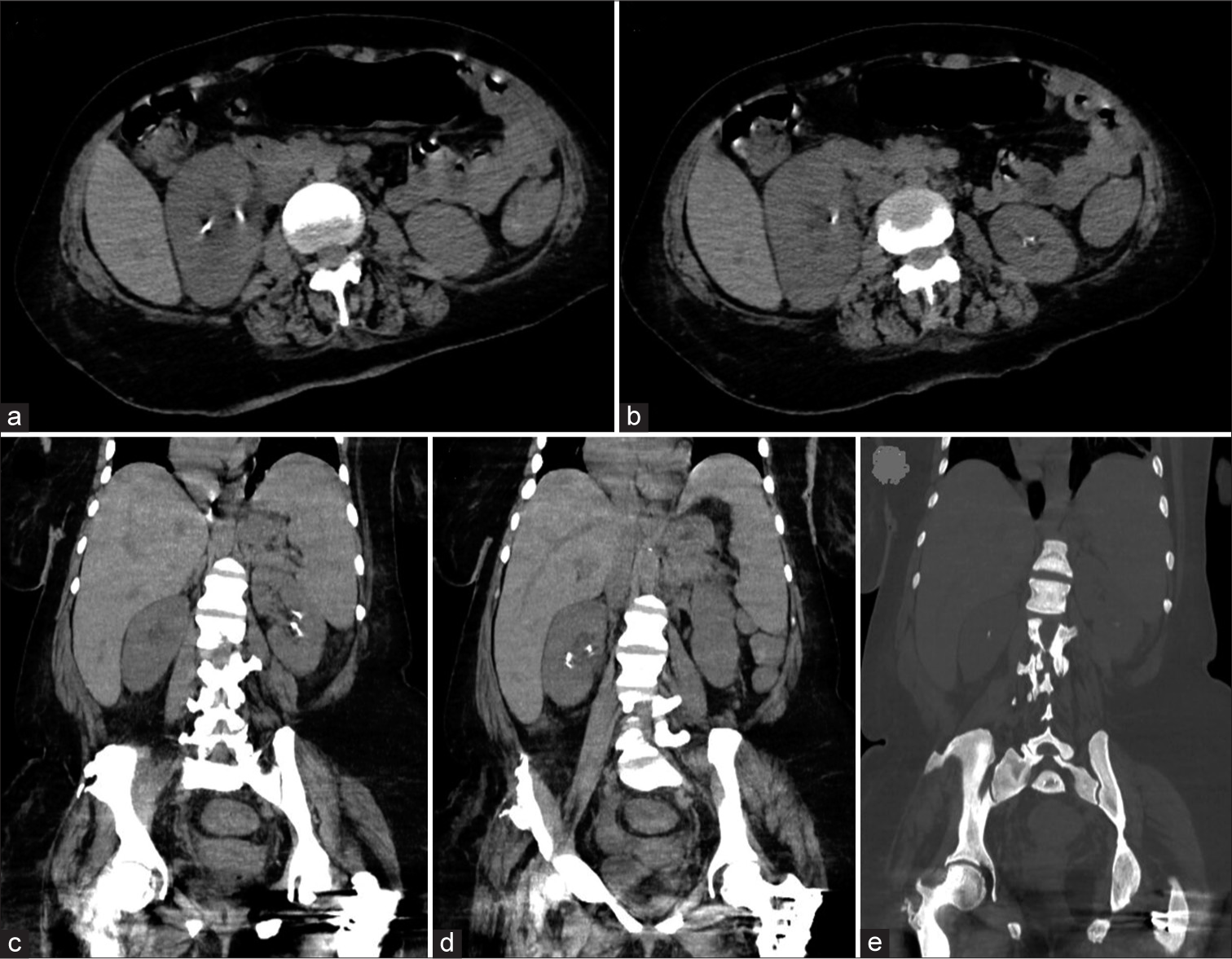 (a-e) Non-enhanced computed radiography of the abdomen showing bilateral renal stones, hepatosplenomegaly, and generalized increased bone density of the spine and pelvic bones, with metallic artifacts due to fixation of both femoral neck old fractures.