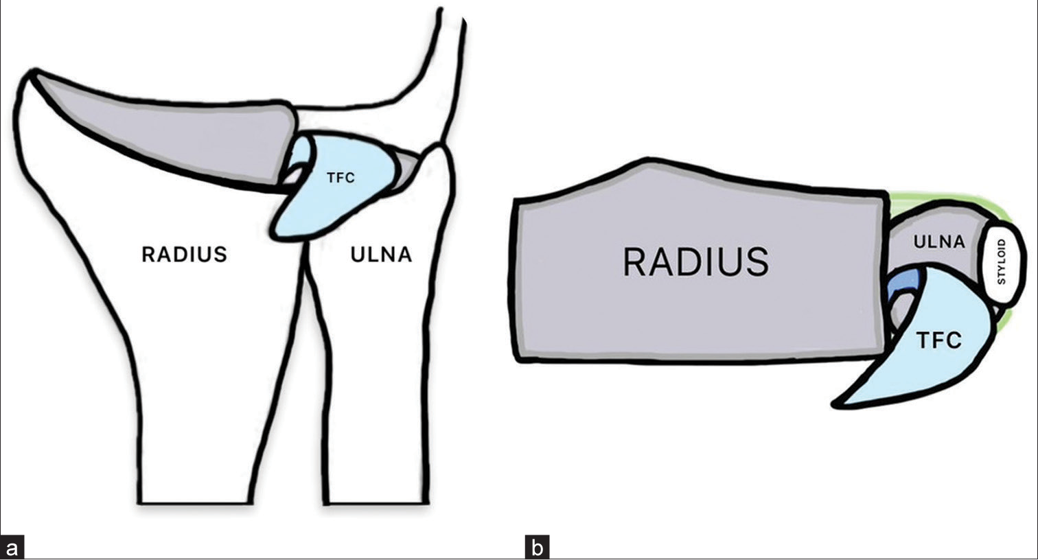 (a) Simplified coronal diagrammatic representation of the index case showing the displaced fragment of the triangular fibrocartilage (TFC) (in blue). (b) Simplified axial diagrammatic representation of the index case showing the displaced fragment of the TFC (in blue).