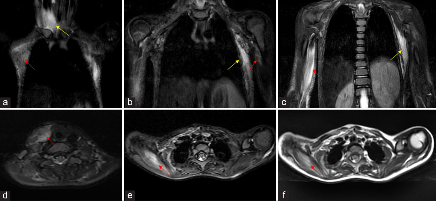 MRI of bilateral shoulders and chest wall showing pre-osseous soft tissue changes in 5 year old child with FOP. (a-c) Serial coronal STIR images shows hyperintense signal (red arrow) along the fibres of right sternocleidomastoid (a, yellow arrow), left coracobrachialis (b red arrow), right coracobrachialis and biceps and overlying subcutaneous fat (c red arrow), subcutis and intercoastal muscles of left side of chest wall (b, c yellow arrows). (d-e) Serial axial STIR images shows edema (red arrow) along the right sided strap muscles and sternocleidomastoid, bilateral supraspinatus (Right much more than left). (f) Axial T2 image shows hyperintense signal (red arrow) along the fibres of right supraspinatus, which also appears bulky due to the edema.