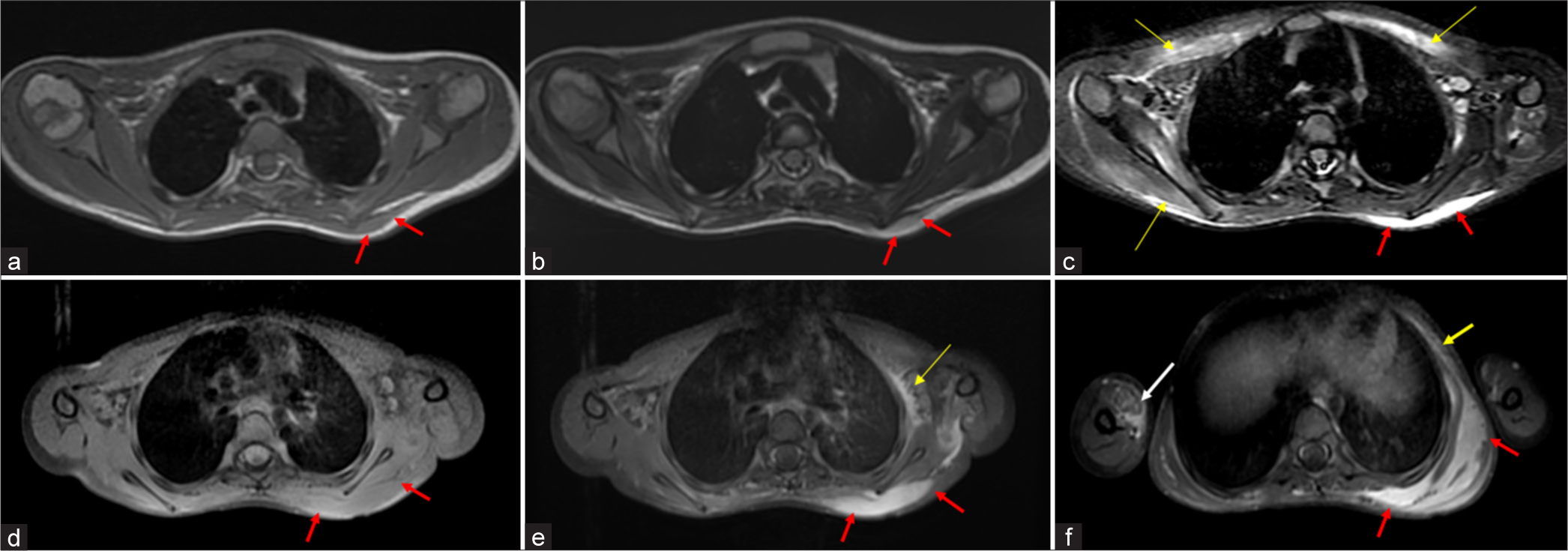 MRI of bilateral shoulders and chest wall showing pre-osseous soft tissue lesion in 5 year old child with FOP. (a) Axial T1WI shows a soft tissue mass (red arrows) in the left scapular region in the subcutaneous plane which is iso-intense to the muscle. (b) Axial T2WI and (c) corresponding axial STIR image shows the mass (red arrows) to have a hyperintense signal. STIR hyperintense edema is also seen in the pectoralis major muscles and right rotator cuff muscles (yellow arrows). (d) Axial pre-contrast T1 fat suppressed image and (e-f) post contrast images shows intense enhancement of the soft tissue lesion, which is seen to extend along the trapezius muscle, left intercoastal muscles(yellow arrow) and overlying subcutis of the chest wall. (d-f) Note that the contrast study were performed 6 days after the initial base sequences(a-c) and shows a significant increase in size. Enhancement was also seen within the involved right arm muscles (f: white arrow) and rest of the involved muscles which were edematous (not shown here). Pre-osseous mass scapular region 6-7-21, Scapular mass contrast 12-7-21.