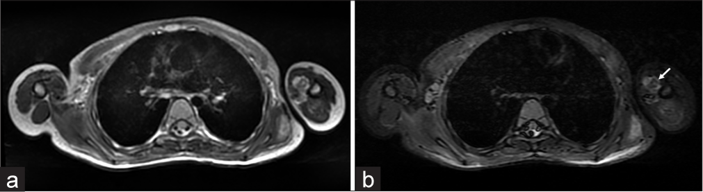 MRI showing ossific foci left arm muscles. (a) Axial T2WI and (b) STIR image showing central hypointense foci(white arrows) within the hyperintensity in the left coracobrachialis corresponding to ossification.