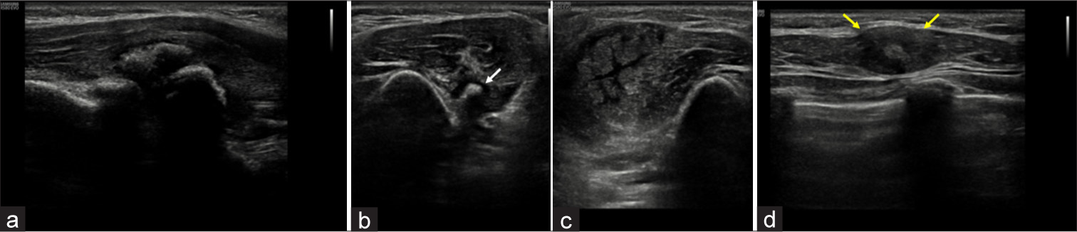 Ultrasound of arm and chest wall in a 5 year old child with FOP. (a) Grey scale image of the left coracobrachialis muscle showing coarse echogenic areas with dense posterior acoustic shadowing suggesting calcification/ossification. (b,c) Spilt screen image shows (b) osseous lesion in left arm muscles showing ossific focus (white arrows) but no significant edema, (c) comparing it with pre-osseous lesion with extensive edema without ossification in the right arm muscles. (d) Grey scale image of right pectoralis muscle appears focal bulky (yellow arrows) with loss of normal fibrillar pattern and a central echogenic focus, possibly soft calcification.