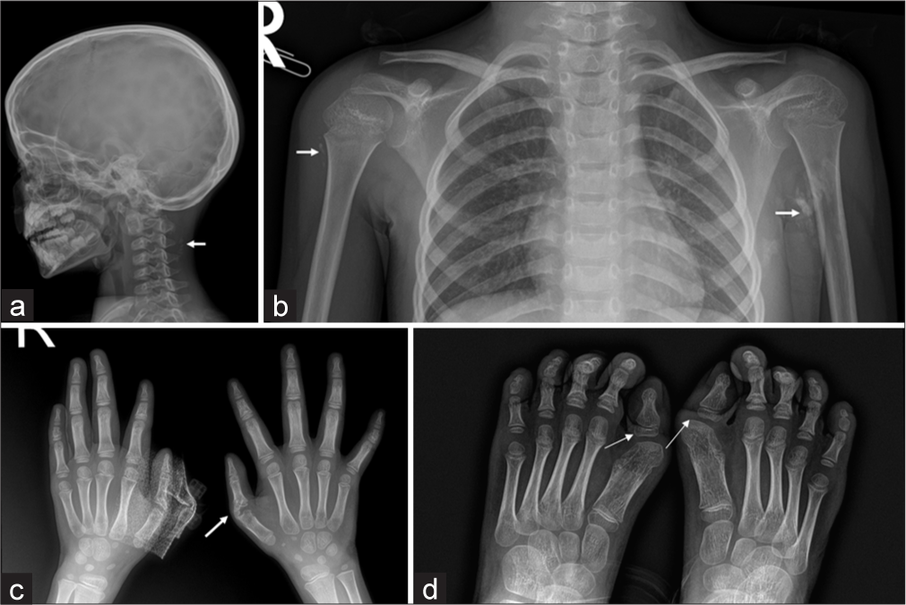 Radiographs showing skeletal anomalies and soft tissue ossification in a 5 year old child with FOP. (a) Radiograph Skull lateral view, (b) chest with bilateral shoulders shows focal areas of heterotopic ossification (white arrows) in the paravertebral soft tissue and muscles of both upper arms. (c) Radiograph of both hands PA view shows short proximal phalanx of second and fifth digit of both hands with heterotopic ossification (white arrows) bridging across the left first metacarpophalangeal joint. (d) Radiograph of both feet shows short first metatarsals, mono-phalangeal great toe with hallux valgus deformity.