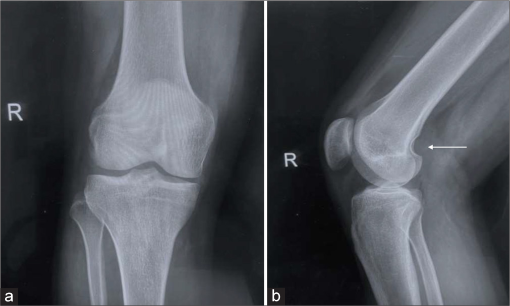 Conventional radiograph of the knee in (a) anteroposterior view and (b) lateral view showing smooth scalloping above the lateral femoral condyle (arrow).