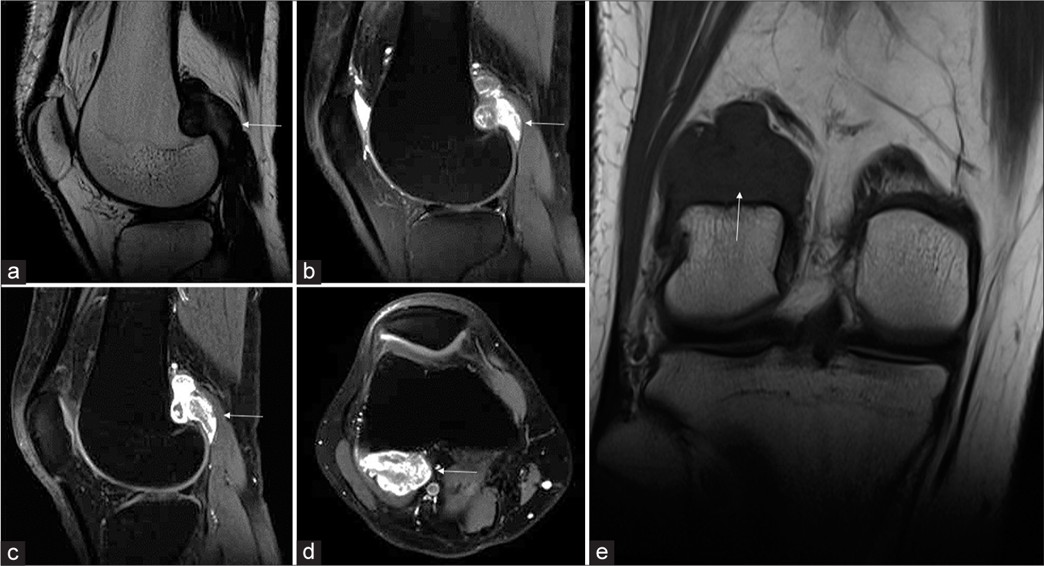 (a) Sagittal T2-weighted and (b) Proton density fat suppressed (PDFS) images of the right knee show a T2 iso to hypointense, PDFS hyperintense lesion (white arrow in a and b) in the popliteal fossa, deep to the lateral head of the gastrocnemius. (c) Post-contrast T1 fat-saturated sagittal and (d) axial images show avid enhancement of the lesion (white arrow in c and d). Underlying smooth scalloping above the lateral femoral condyle is noted. (e) Coronal T1-weighted sequence shows that the lesion is hypointense (white arrow).