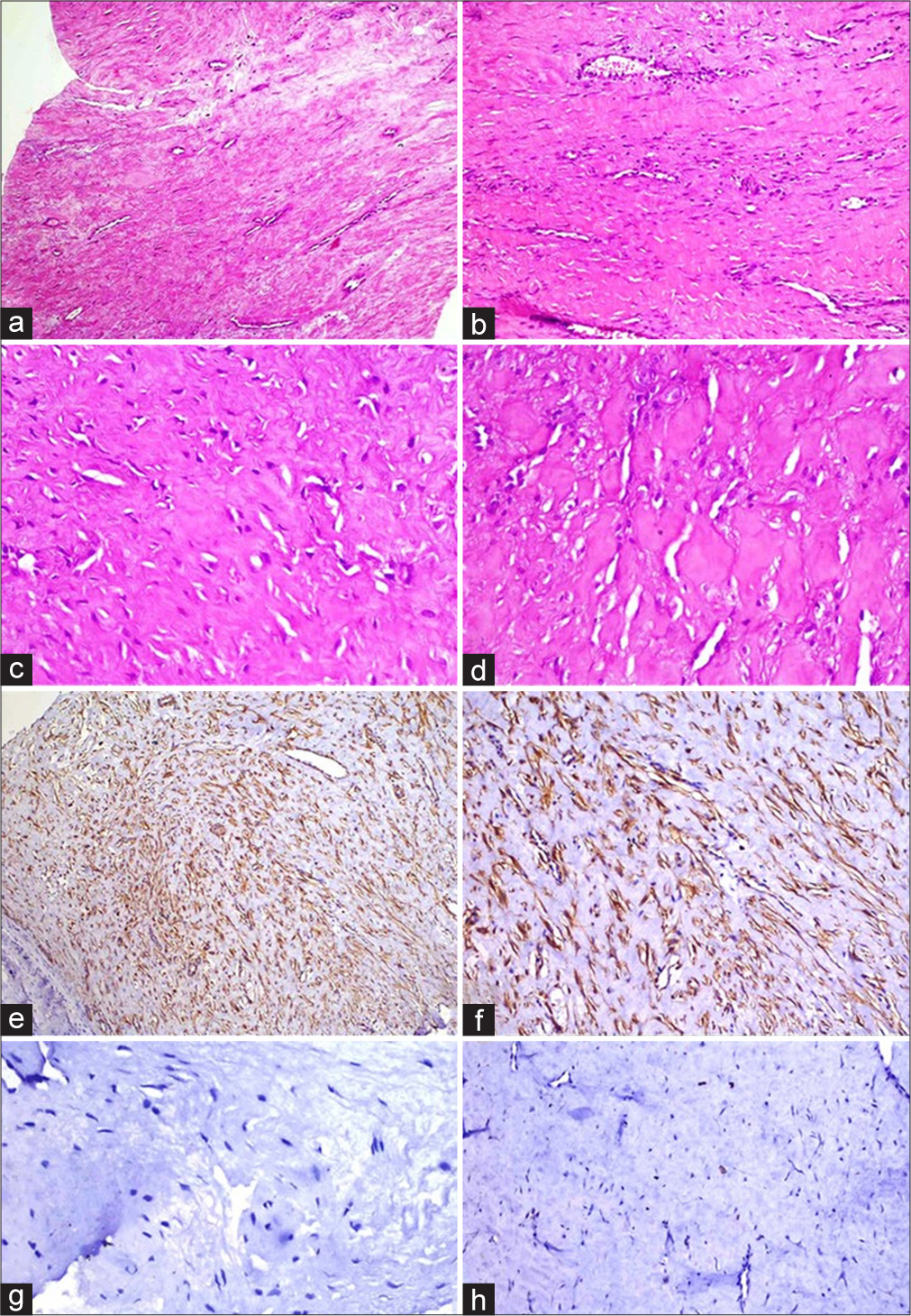 (a) Hematoxylin and eosin-stained section shows fascicles of bland spindle cells arranged in a collagenous stroma (×100). (b) Hyalinized areas of desmoid tumor with staghorn vasculature (×200). (c and d) Prominent stromal hyalinization along with compressed and thin-walled vessels (×400). (e) Tumor cells immunopositive for smooth muscle actin (SMA; ×100). (f) Tumor cells displaying beta-catenin expression (β catenin; ×200). (g) Tumor cells negative for S-100 (S100; ×400). (h) Tumor cells displaying <1% of ki-67 activity (Ki67; ×200).