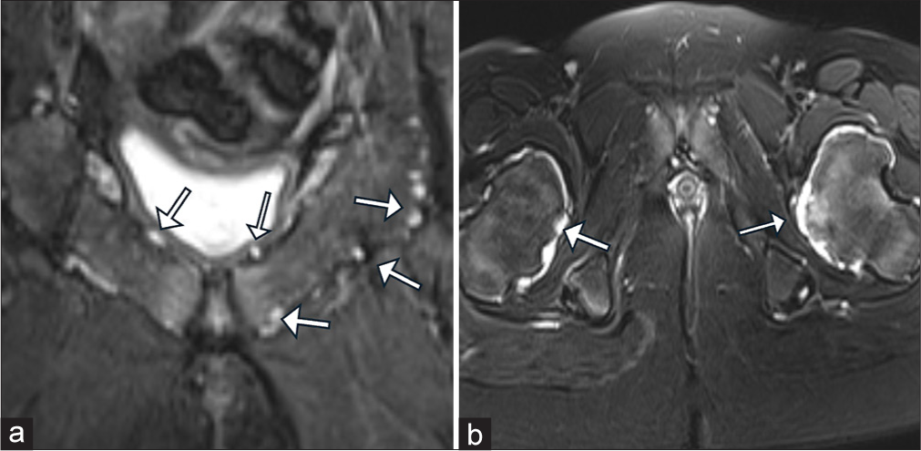 (a) Oblique coronal and (b) axial T2 Fat saturation images through pubic symphysis and bilateral femoral neck demonstrates multiple diffuse osteochondromas (white arrows in a and b) scattered throughout the pelvic bones and femoral necks.