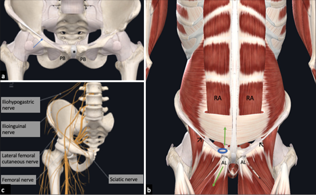 Diagrammatic representation of the anatomy of the groin. (a) Normal anatomy of the symphysis pubis composed of bilateral pubic bones (PB) with intervening fibrocartilaginous articular disc (*). The blue arrow denotes the inguinal ligament. (b) Schematic representation of the relationships and sites of attachment of the major muscles—the rectus abdominis (RA), adductor longus (AL)— and the inguinal ligament (black arrows) to the symphysis pubis. Green arrows denote the direction of the major force vectors to which the PB is commonly exposed during athletic activities. The lateral margin of the common adductor-RA aponeurosis lies just deep to the superficial inguinal ring (blue circle). (c) Nerves coursing through the groin region.