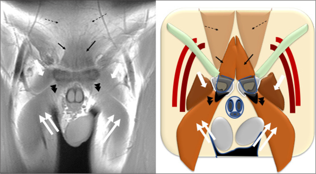 Oblique coronal T1-weighted image through pubic tubercle (left) and diagrammatic representation (right). Pyramidalis (thin black arrow) continuing with the anterior pubic ligament (not as well seen enface) and thence to the adductor longus aponeurosis (Black arrowheads) and adductor longus muscle (double white arrow). Pectineus (large white arrow) seen lateral to the adductor longus on this anterior coronal section. The rectus abdominis muscles (dashed black arrow) coursing posterosuperior to the pyramidalis and inserting on the superior surface of the pubic ramus.