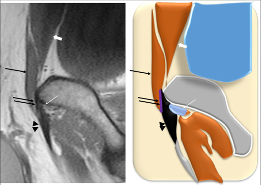 Parasagittal T1-weighted image through pubic tubercle (left) and diagrammatic representation (right). Pyramidalis (thin black arrow) inserting on anterior pubic ligament (double thin black arrow) and thence to the adductor longus aponeurosis (Black arrowheads). Adductor fibrocartilage deep to the aponeurosis (thin white arrow). The rectus abdominis (thick white arrow) inserting on the superior surface of the pubic ramus.