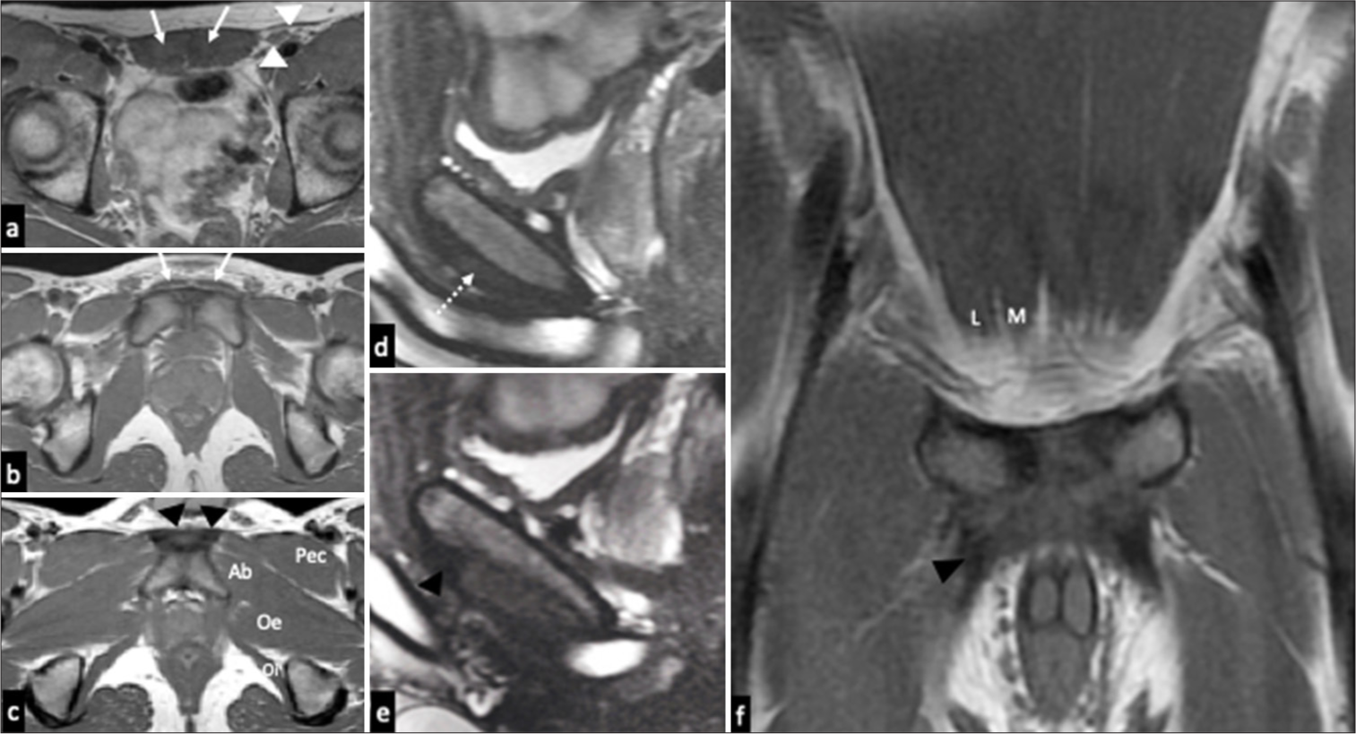 Normal MR imaging of the symphysis pubis. (a, b and c) T1-weighted axial MR images superior to, at and inferior to the symphysis pubis. (a) The medial and lateral heads of rectus abdominis muscles (white arrows) have been shown. The anterior wall rectus sheath continues with the external oblique aponeurosis and forms the anterior as well as the posterior walls of the inguinal canal (white arrowheads). (b) The rectus abdominis tendons blend anterior to the pubic bones and insert onto the anterior pubic ligament. (c) Demonstrates the adductor longus tendons (black arrowheads), seen as areas of triangular dark signal arising inferior to the pubic crest. The adductor brevis (Ab), obturator externus (Oe), obturator internus (Oi), and pectineus (Pec) muscles are indicated. (d) Midline sagittal T2-weighted image showing normal rectus abdominis-adductor aponeurotic plate/pre-pubic plate (dotted arrow). (e) Sagittal T2-weighted image, some slices lateral to midline showing normal rectus abdominis-adductor aponeurosis /pre-pubic plate (black arrowhead) with origin of the adductor tendon inferiorly. (f) Coronal T1-weighted image showing both heads (M, L) of the distal right rectus muscle. The tendons from bilateral medial heads (M) blend with each other and merge with anterior pubic ligament. The lateral head (L) arises from the pubic tubercle and crest. The adductor longus tendon (black arrowhead) arises from the anterior part of pubic bone, inferior to the crest and blends with the contralateral tendon across the midline.