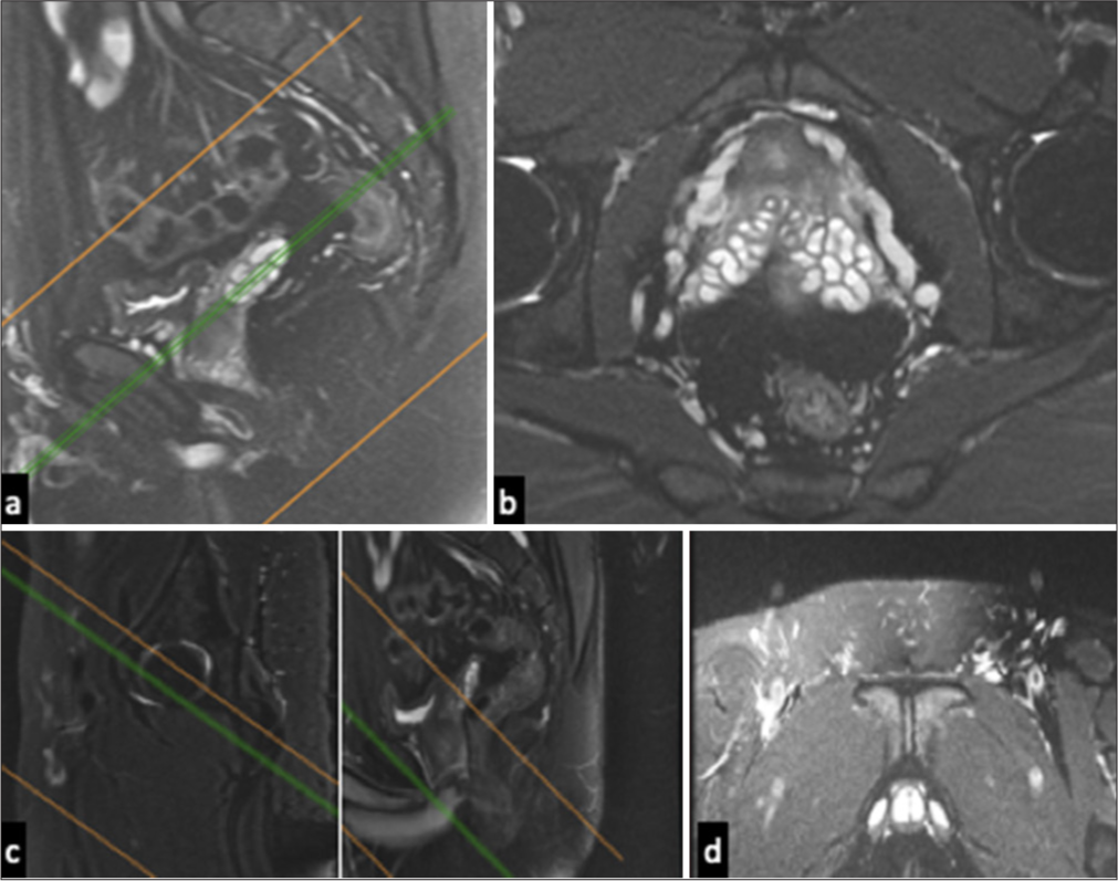 (a) Sagittal T2-weighted fat-suppressed image obtained near the medial acetabulum shows the plane (lines) determined for axial oblique magnetic resonance (MR) imaging of the pubic region, which parallels the iliopectineal line and is perpendicular to pubic symphysis. (b) Axial oblique T2-weighted fat-suppressed image shows normal muscles around the pubic symphysis. (c) Sagittal T2-weighted fat-suppressed image shows the plane (lines) determined for coronal oblique MR imaging of the pubic region, which is perpendicular to the iliopectineal line and parallel to the pubic symphysis. (d) Coronal oblique T2-weighted fat-suppressed image shows normal muscles around the pubic symphysis.