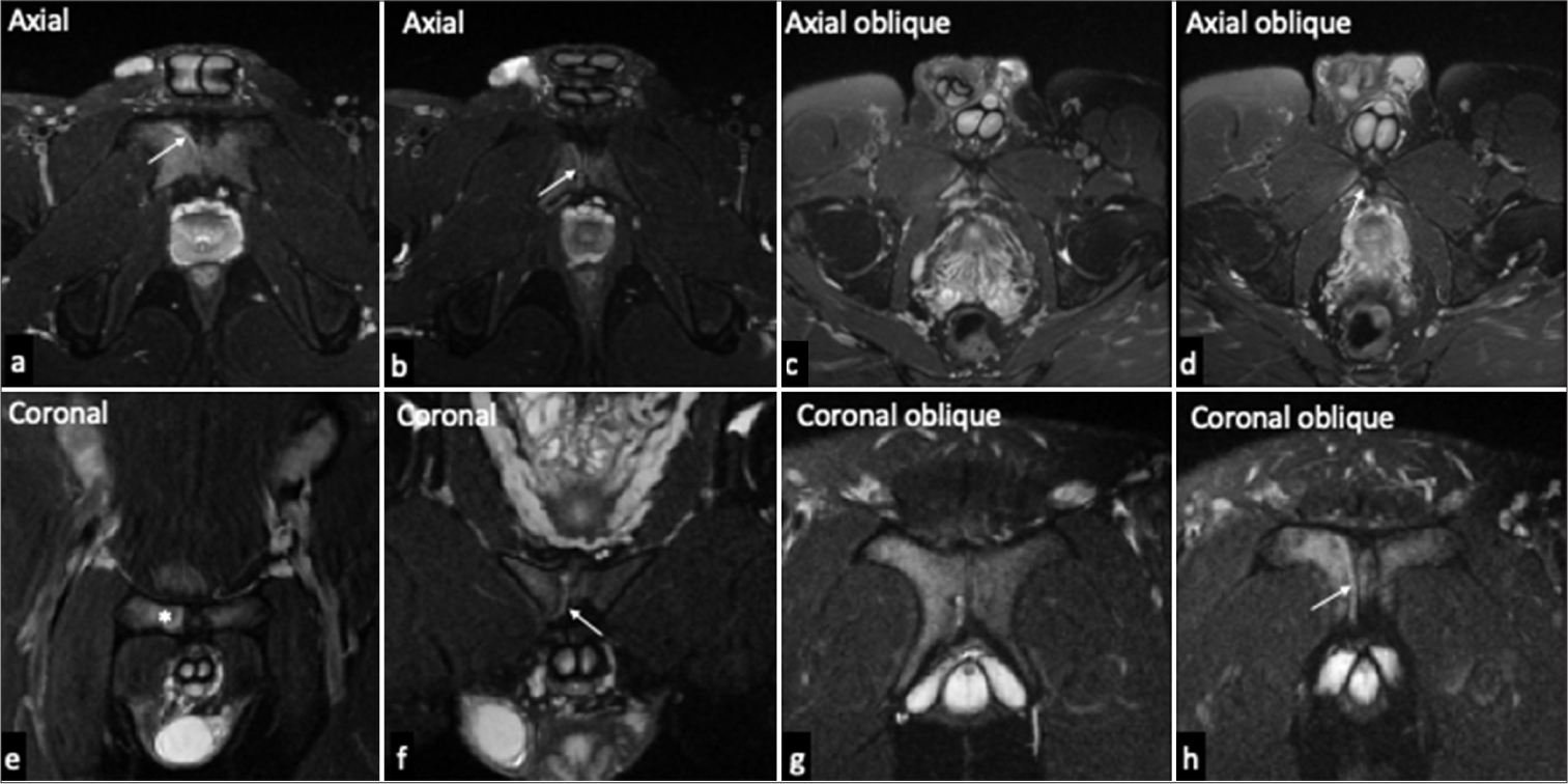 Secondary cleft (white arrow) in a 24-year-old male basketball player with right sided groin pain. (a and b) Serial Axial (c and d) Axial oblique, (e and f) Coronal, and (g and h) Coronal oblique T2-weighted fat-suppressed serial images of the symphysis pubis depicts a crescentic hyperintense area adjoining the hyperintense signal interpubic articular disk along the anterior-inferior margin of the medial pubic body, close to the common adductor-rectus abdominis aponeurosis. Mild adjacent bone marrow edema osteitis pubis-denoted by * is noted on the right side.