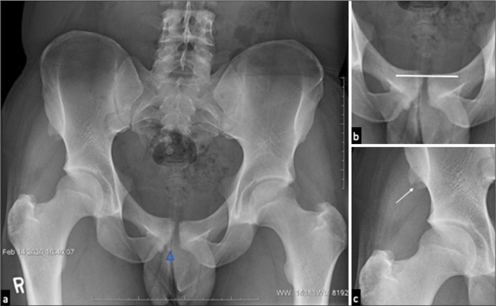 (a) Plain radiograph of a 20-year-old male footballer with right-sided groin and hip pain reveals osteitis pubis with subchondral erosive change, articular surface irregularity and sclerosis of the symphysis pubis-findings being more prominent on the right side. Small soft-tissue ossification (blue arrowhead) at the site of adductor tendon attachment likely representing calcific tendinopathy. (b and c) Magnified radiographic images reveal a prominent offset at the symphysis pubis (straight horizontal line showing the offset) representing macro-instability and old avulsion injury (white arrow) at the right anterior superior iliac spine, site of sartorius origin.