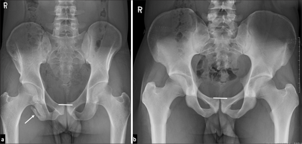 (a) Plain radiograph of pelvis of a 21-year-old footballer with osteitis pubis showing prominent step-off (straight horizontal line) at the symphysis suggesting macro-instability and chronic apophyseal avulsion injury at the hamstring origin, right ischial tuberosity (arrow). (b) Plain radiograph of pelvis of a 20-year-old male footballer showing sclerosis related to chronic osteitis pubis with insignificant articular step-off (straight horizontal line) at the symphysis suggesting micro-instability.