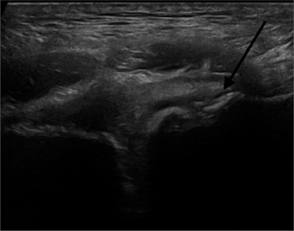 Ultrasonography in a 36-year-old male footballer demonstrating chronic changes at pubis with diffuse bony irregularity of osteitis pubis (long black arrow)-evolved changes over time.