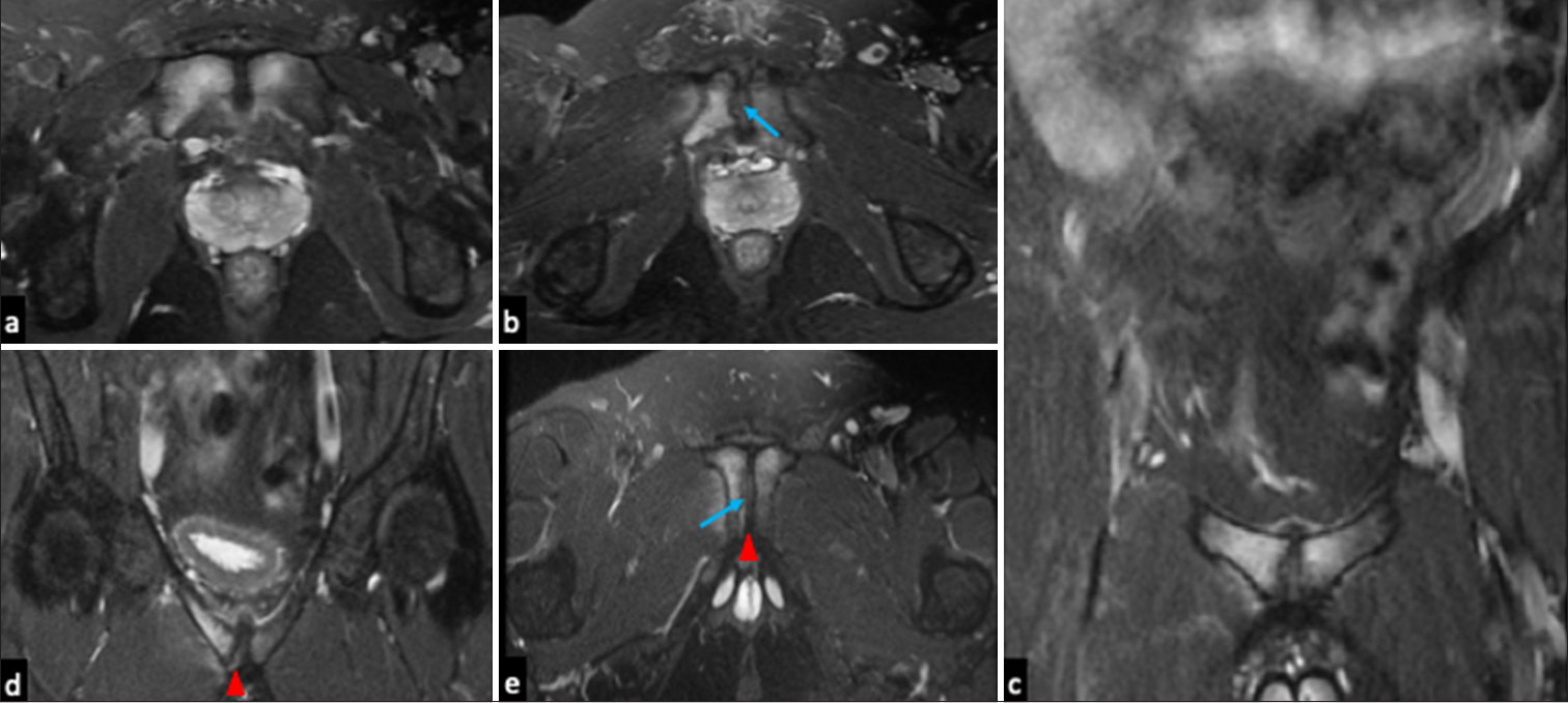 Magnetic resonance images of osteitis pubis in a 17-year-old athlete with groin pain. (a and b) Axial T2 fat-suppressed images (c and d) coronal T2 fat-suppressed images and (e) coronal oblique fat suppressed images reveal bilateral parasymphyseal bone marrow edema with articular surface irregularity (blue arrow) showing right-sided dominance and presence of small right secondary cleft (red arrowhead).