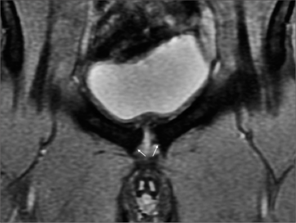 17-year-old cricketer, painful left groin. Coronal T2 fat-suppressed images of the symphysis pubis reveals advanced degenerative changes with pubic symphyseal widening and marked irregularities in the pubic articular surface, more on the left side (arrows).