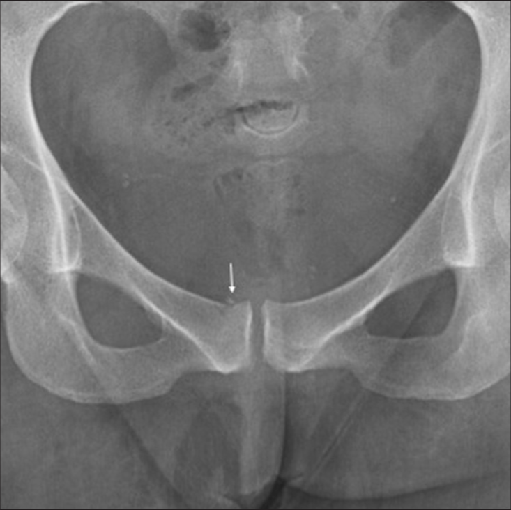 Plain radiograph in a 41-year-old female tennis player showing osseous avulsion at the site of right rectus abdominis insertion (arrow).