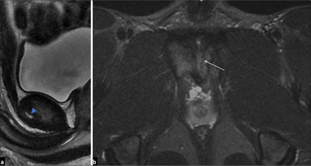 (a) Sagittal fat saturated MR images showing prepubic plate delamination (blue arrowhead) (b) Coronal oblique fat saturated MR images showing left sided osseous irregularity at pubic margin (white arrow).