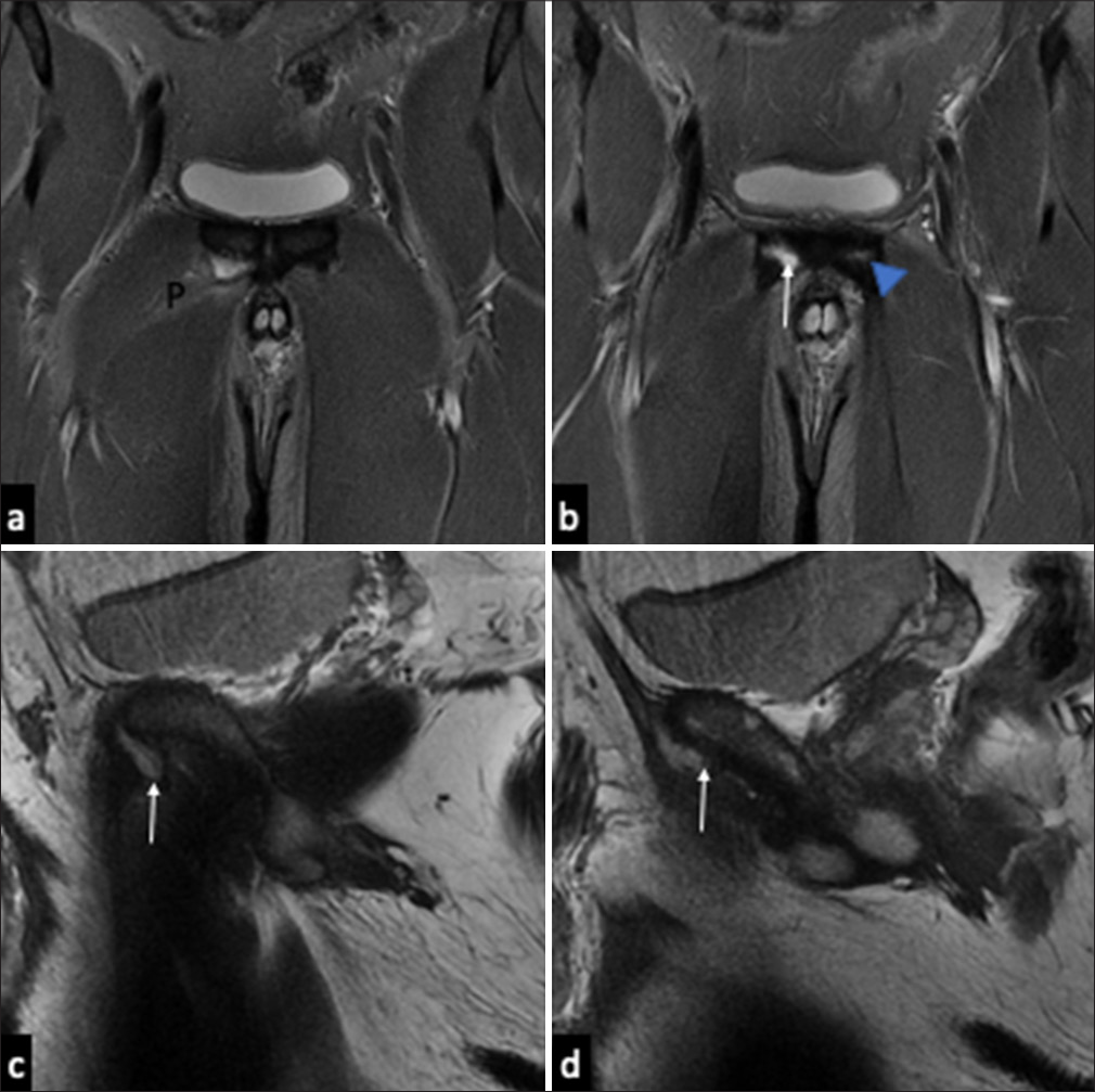 31-year-old footballer, right sided acute groin pain post play. (a and b) Coronal magnetic resonance images show traumatic avulsion of the right adductor longus tendon (white arrow) without significant retraction, and edema in the pectineus (P) muscle. Note the pre-existing tendinosis at the left adductor longus (blue arrowhead) giving credence to chronic adductor weakness predisposing to this tear. (c and d) Sagittal images reveal fluid marginating the adductor origin, with loss of normal hypointense triangular tendinous signal (white arrows).