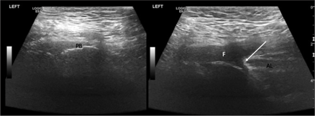 Ultrasonography in a 52-year-old male with sports related groin injury showing adductor longus (AL) tendinous avulsion. A retracted AL tendon stump (white arrow) located at the proximal insertion near the pubic bone (PB) associated with a fluid (F) collection (sero-hematoma).