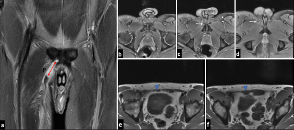 (a) Coronal oblique images in a 22-year-old cricketer demonstrate a full-thickness tear of the right adductor longus tendon from its origin (double headed red arrow), with 5 cm retraction and intramuscular tear at the medial fibers of pectineus (P). (b, c and d) Serial axial images show diminished asymmetrical tendon size with peritendinous free fluid (white arrows). (e and f) Noteworthy asymmetric atrophy (blue arrowheads) of the right rectus abdominis muscle (lateral head more than the medial head) on T1-weighted axial images lends evidence to the predictable unsupported/unopposed force vectors at the pubis.