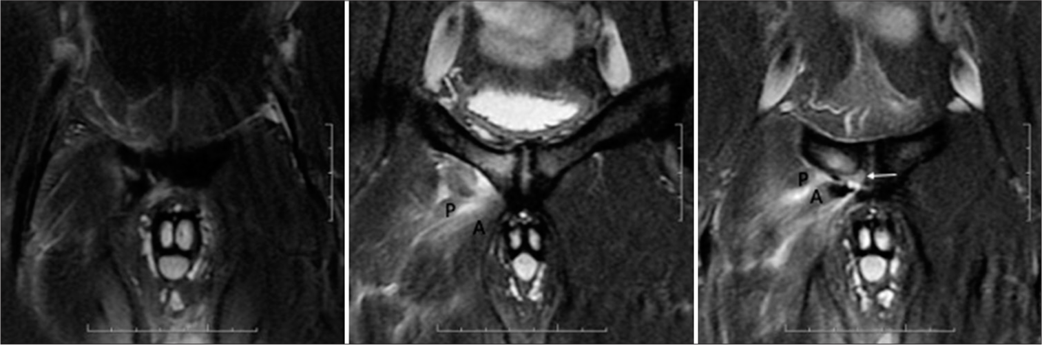 32-year-old footballer with acute groin pain. Coronal T2 fat-suppressed magnetic resonance images reveal full thickness tear of the right adductor longus (A) and pectineus (P) origins with bony avulsion (white arrow) at the pubis.