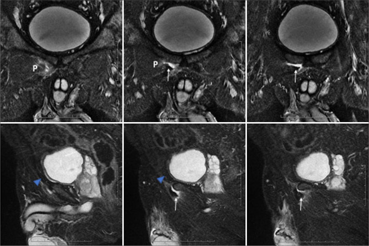 Coronal and sagittal T2 fat-suppressed serial magnetic resonance images showing complete avulsion of adductor longus fibrocartilage (white arrow), partial tear of the pectineus (P), and intact pyramidalis (blue arrowhead) representing type 4 PLAC injury.