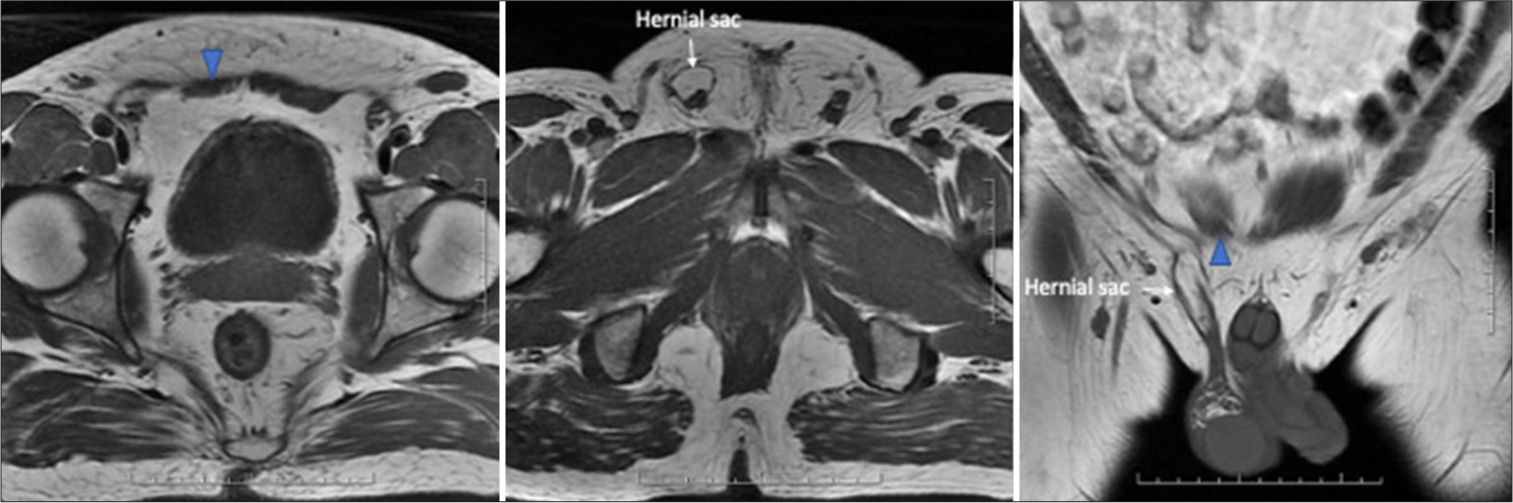 T1-weighted axial magnetic resonance images revealing atrophy of the right rectus abdominis muscle (blue arrowhead) and presence of ipsilateral inguinal hernia (white arrow demonstrating the hernial sac).