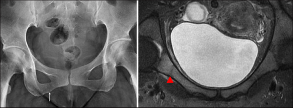 Plain radiographs in a 33-year-old soccer player with recent onset right groin region pain showing stress fracture of the right inferior pubic ramus (white arrow). Subsequent magnetic resonance (Coronal T2 fatsuppressed) images in the same player revealed an additional stress fracture of the right superior pubic ramus (red arrowhead) as well with surrounding bone marrow and soft-tissue edema.