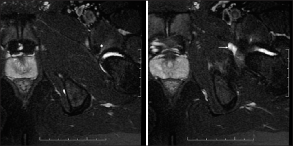 Axial T2-weighted fat-suppressed magnetic resonance images in a 21-year-old mail with groin pain showing traumatic iliopsoas tendinitis (*) and iliopsoas bursitis (arrow).