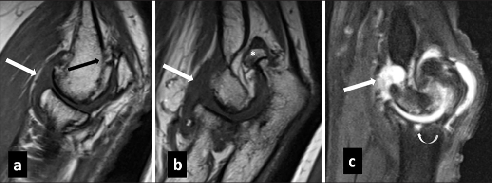 (a,b) Sagittal T1 weighted and sagittal (c) T2 weighted fat saturated images in a case of post infective osteoarthritis show degenerative changes in radiocapitellar and ulnohumeral joints in form of extensive bony osteophytes (black arrow in a), cartilage loss, subchondral cysts (curved white arrow in c) and loose body (* in b). Also note presence of mild joint effusion (white arrow in a-c).