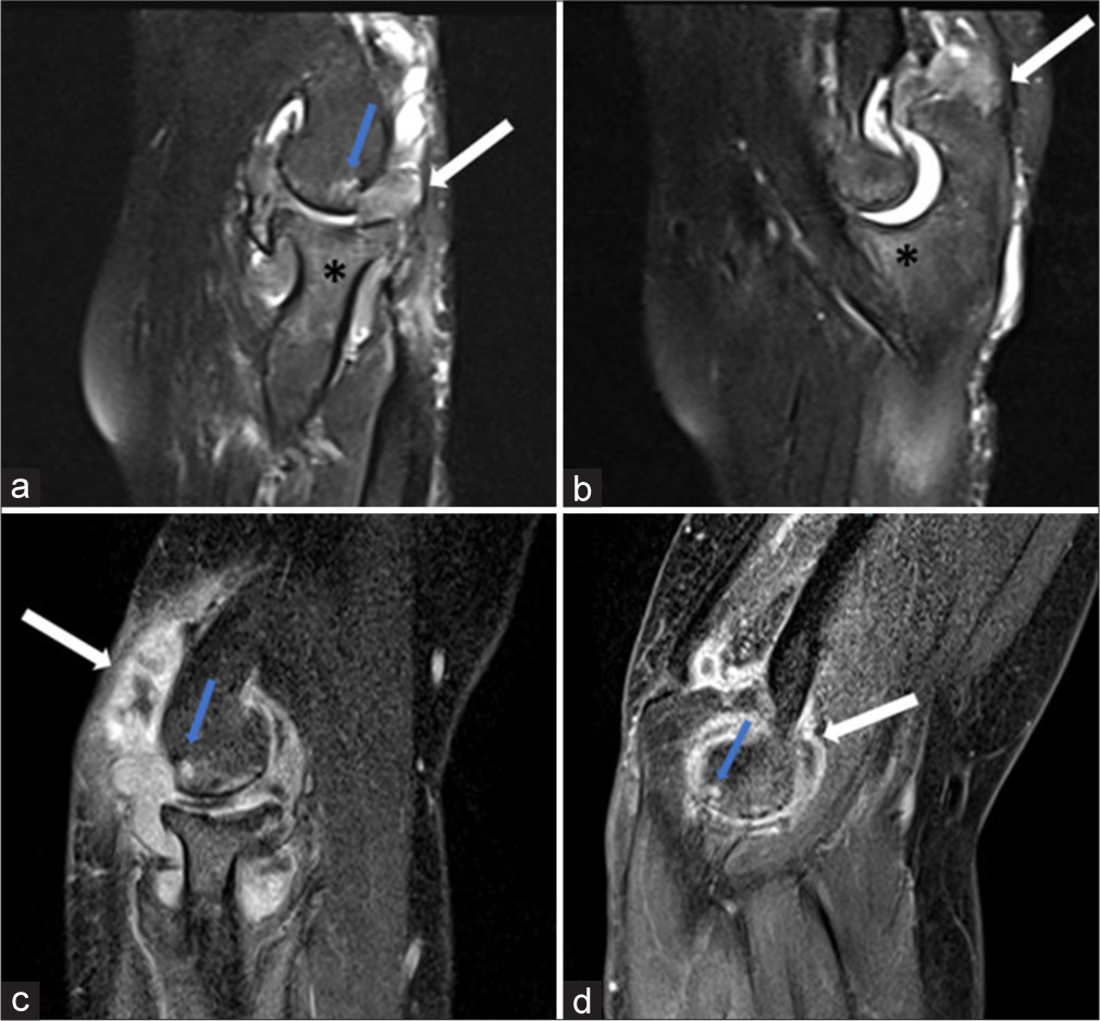 (a,b) Sagittal proton density fat saturated images and (c,d) sagittal post contrast T1 weighted images at the level of radiocapitellar and ulnotrochlear joint in a case of rheumatoid arthritis reveal joint effusion with synovial thickening and proliferation with post contrast enhancement (white arrow in a-d) suggestive of synovitis. Associated bony erosions (blue arrow in a,c,d) and bone marrow edema (* in a and b) were also seen.