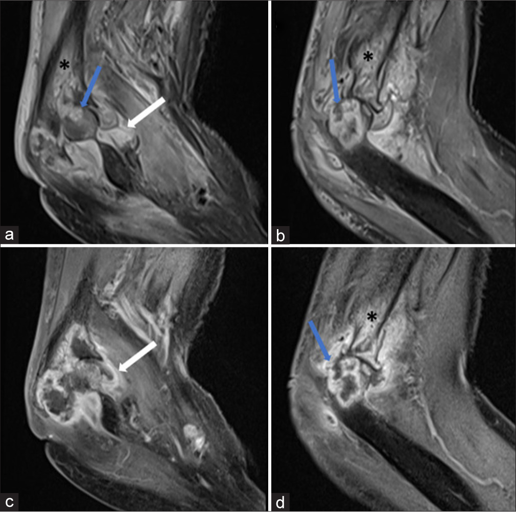 (a,b) Sagittal proton density fat saturated images and (c,d) sagittal post contrast T1 weighted images in a case of septic arthritis reveal joint effusion with synovial thickening and enhancement (white arrow a and c) with large bony erosions (blue arrow in a,b and d) showing peripheral irregular enhancement and marrow edema (* a,b and d). Also note associated perisynovial soft tissue edema.