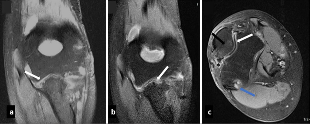 (a) Coronal T2 weighted fat saturated and (b,c) post contrast coronal and axial fat saturated images in a case of septic arthritis reveal ulnohumeral joint space narrowing with synovial thickening and enhancement (white arrow in a,b and c), associated erosions (blue arrow), marrow edema (black arrow in c) and adjacent soft tissue edema (* in c).