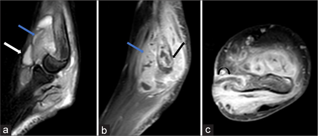 (a) Sagittal T2 fat saturated, (b) sagittal and (c) axial post contrast T1 weighted images reveal elbow joint effusion (white arrow in a) with marked synovial thickening and enhancement (blue arrow in a and b) and bony erosions (black arrow in b) in a case of tubercular arthritis. A sinus tract (curved arrow in c) was also seen extending from medial epicondyle of humerus to overlying skin surface. Also note associated soft tissue edema.