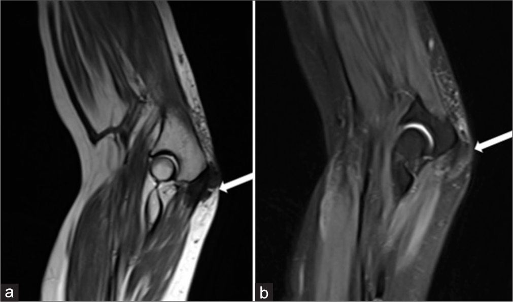 (a) Sagittal T2 weighted and (b) proton density fat saturated images in a patient with chronic gout reveal subcutaneous tophaceous deposit overlying olecranon process (white arrow in a and b).